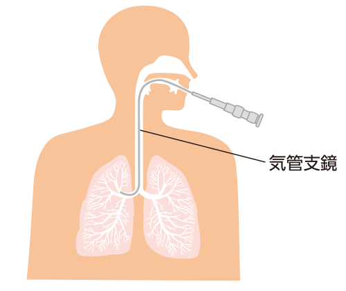 図2：気管支鏡検査