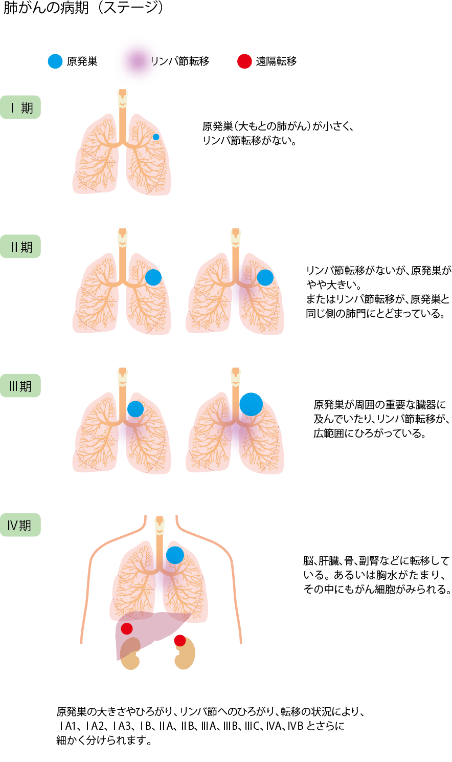 図4：肺がんの病期（ステージ）