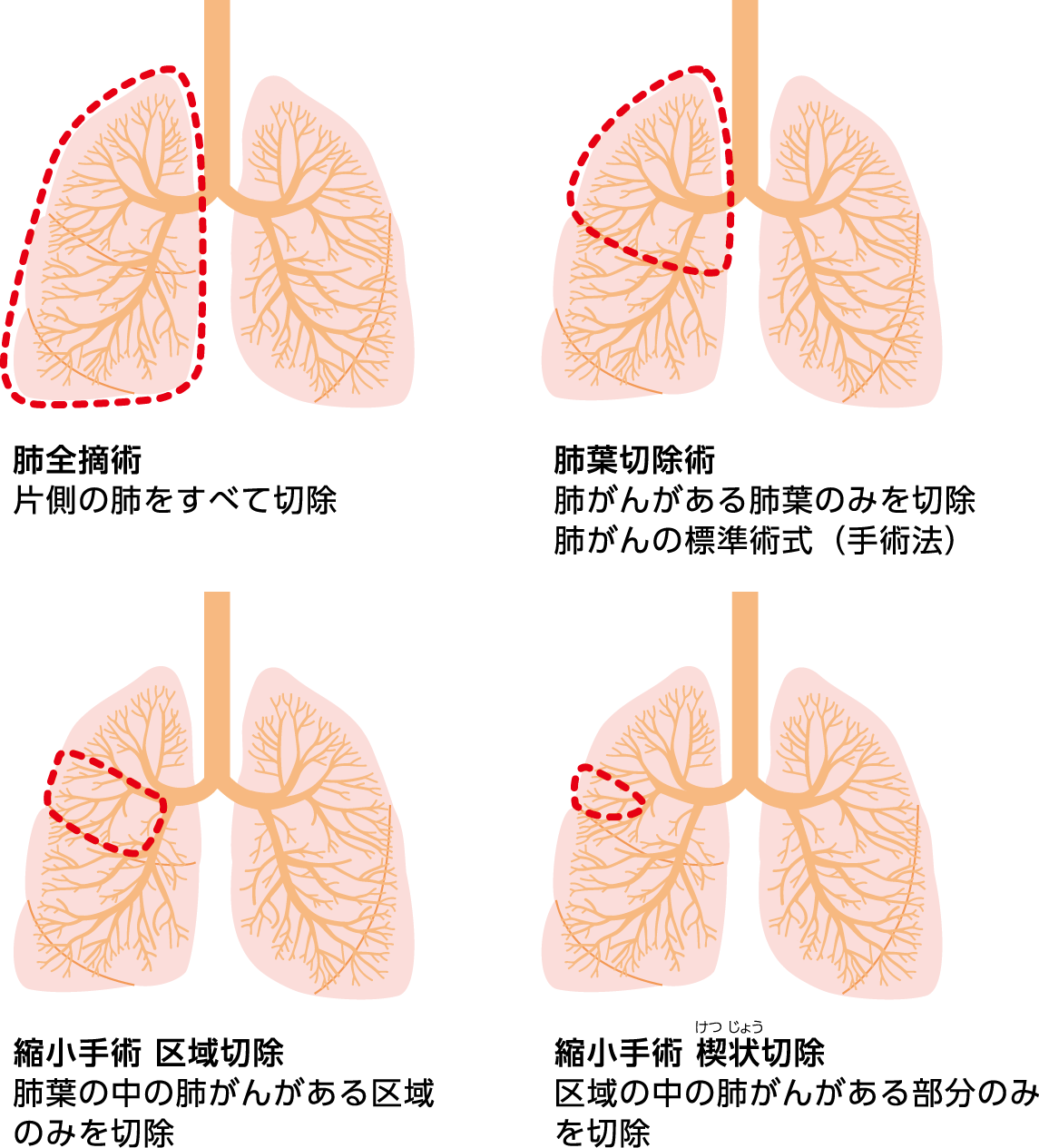 図1：手術方法