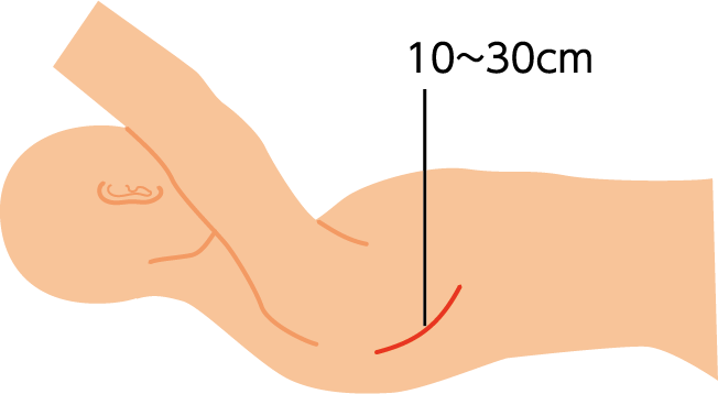 図2：開胸手術