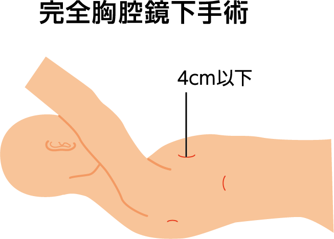 図3：完全胸腔鏡下手術