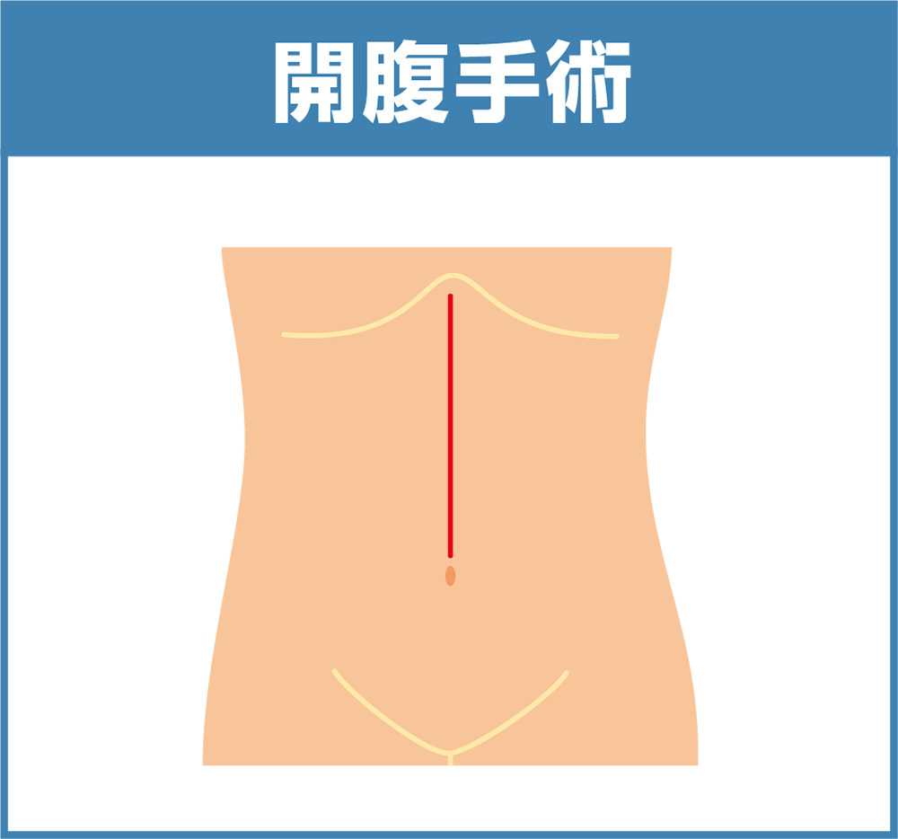 図：開腹手術
