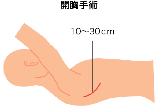 図：開胸手術