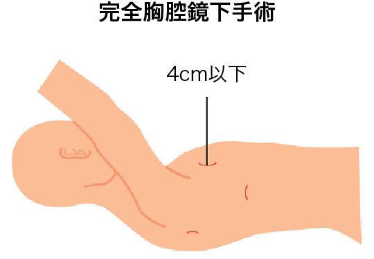 図：完全胸腔鏡下手術