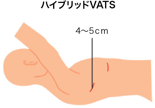 図：ハイブリッドVATS