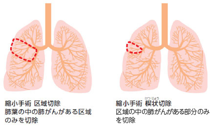肺がんの術式 1