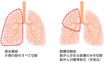 肺がんの術式 2